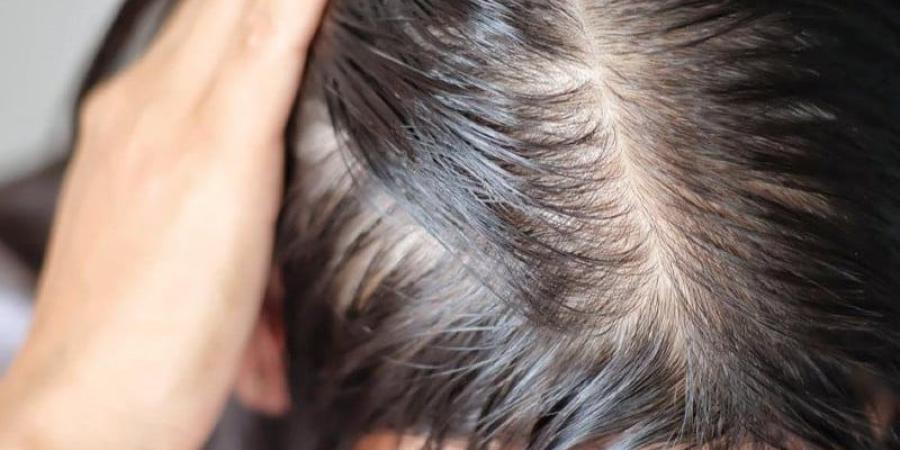 ماء البصل والكركدية لشعر طويل وكثيف وأكثر قوة - وكالة البوصلة الإخبارية