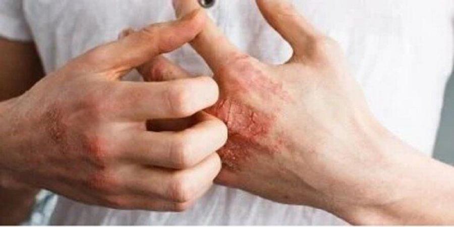 الأكزيما و الصدفية.. كيف تفرق بين المرضين وأسباب ظهور كل منهما؟ - وكالة البوصلة الإخبارية