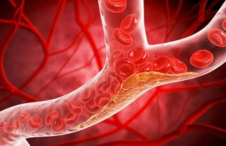 حبوب مبتكرة تقلل الكوليسترول الضار بنسبة 60% وتمنح الأمل لملايين مرضى القلب