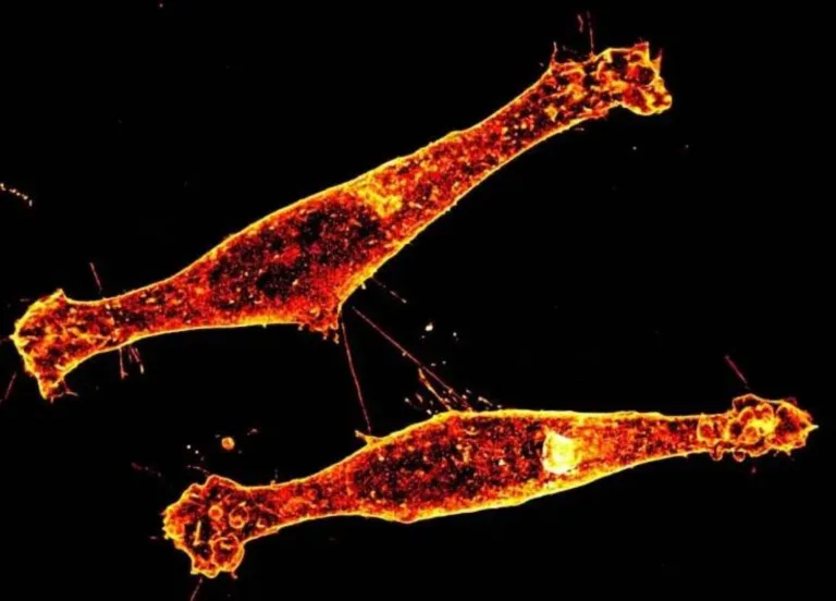 آلية انتشار مرض هنتنغتون في الدماغ تفاجئ العلماء باكتشافات جديدة